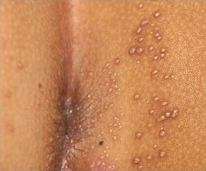 Enfermedades de Transmision Sexual | Unidad Clínica VPH